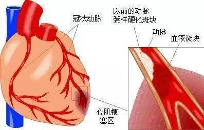 每年100万人突发急性心梗，120分钟内做到这些就能救命