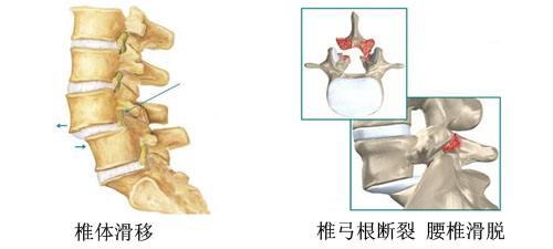 麦琳的腰椎滑脱：忙碌生活中的健康警钟