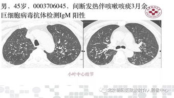 男子甲流后患病毒性肺炎四肢末端花斑：冬季流感高发期的警示