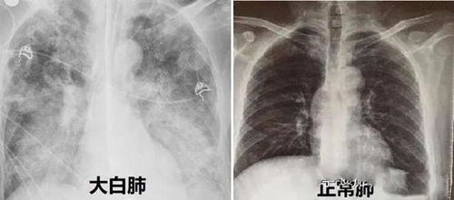 甲流后的意外：从发烧到病毒性肺炎的惊险历程