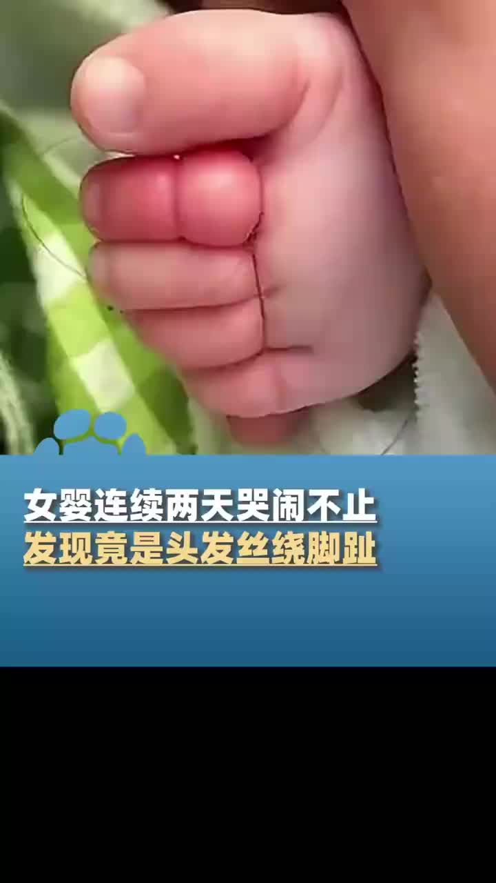 女婴两天哭闹不止，竟是头发丝绕脚趾惹的祸