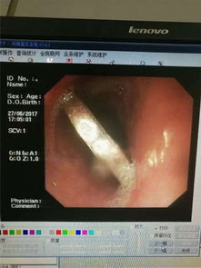 惊险一刻：1岁宝宝胃镜取出硬币背后的温情故事